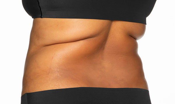 CoolSculpting® Elite Before & After Photos Patient 105, Boston, MA